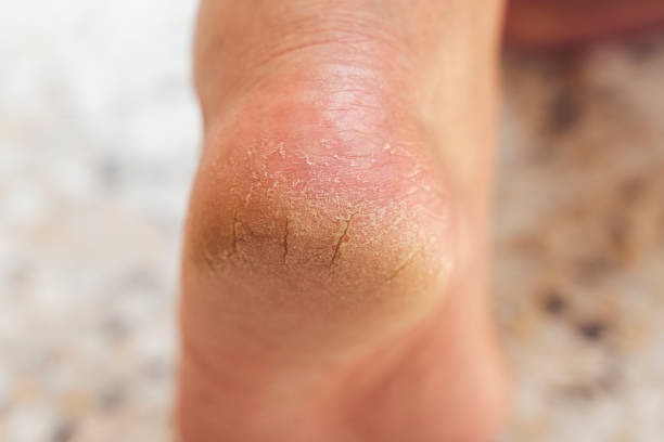 Cracked heels