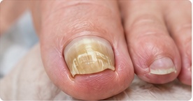 Thickened or discoloured nails