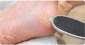Hard skin & callus